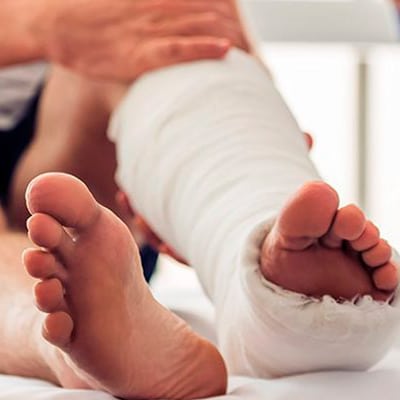 Fractured Collarbone & Broken Bones After A Car Accident in Arizona